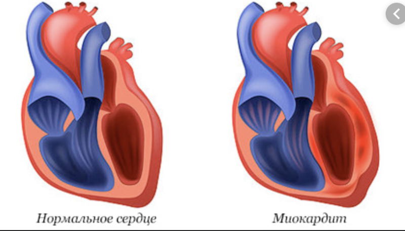 Миокардит картинки для презентации